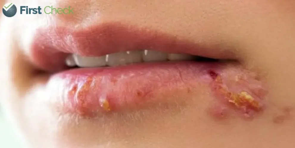 herpes infections