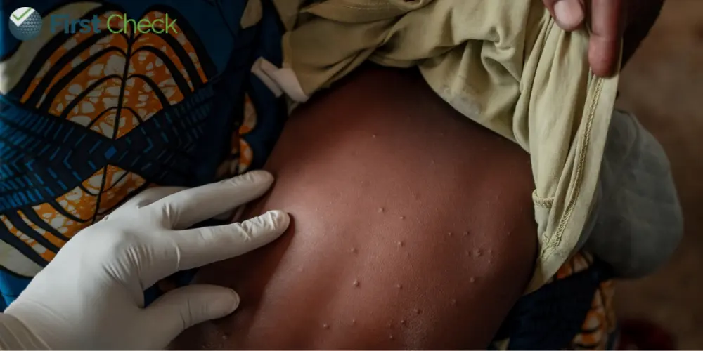 FACT CHECK: Is WHO suggesting lockdowns to tide over rising mpox cases, and is India preparing for one too?