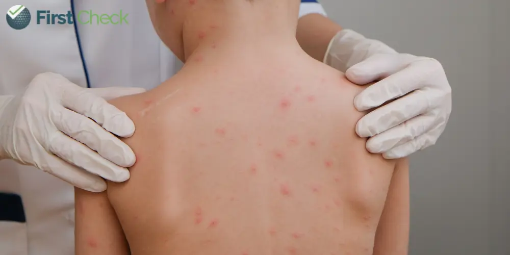 FACT CHECK: Does Chicken Pox spread only after the rashes break out?