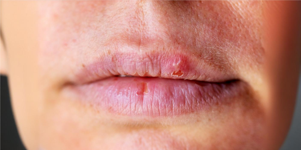 Over 1 in 5 adults worldwide has a genital herpes infection