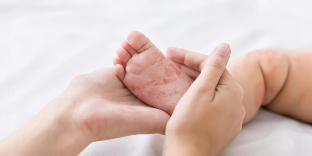 measles