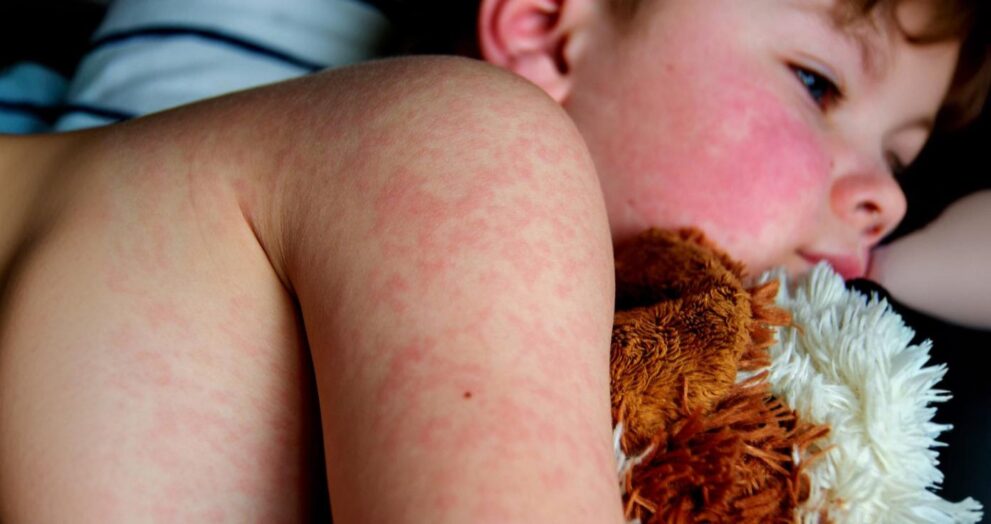 measles