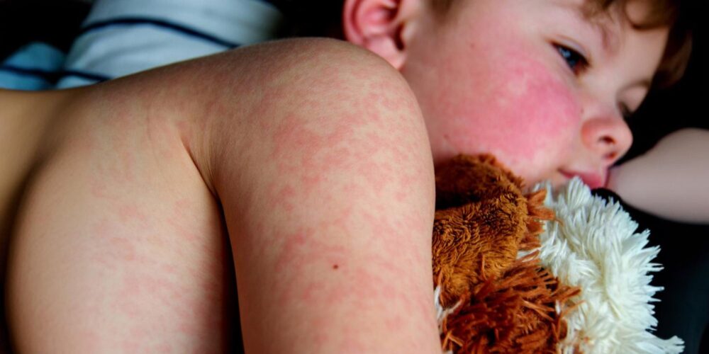 Measles outbreak strikes Southern US, over 250 cases reported