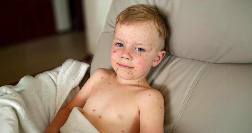 Measles