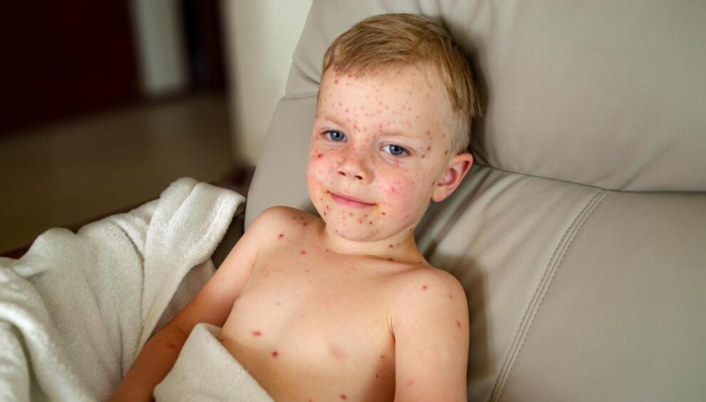 Measles