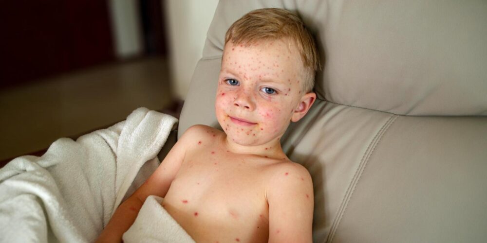 Measles returns: US sees worst outbreak in decades