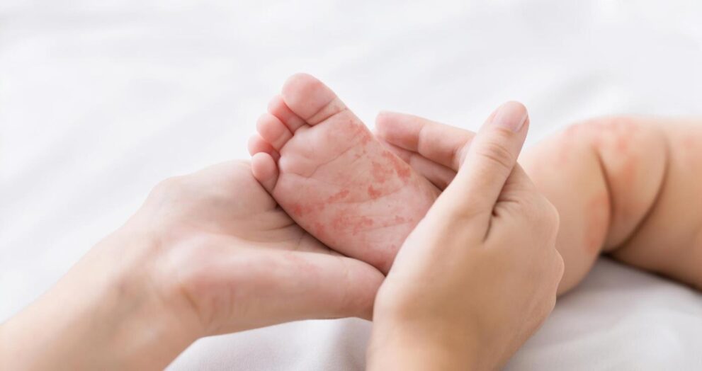 measles