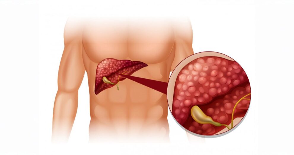 fatty liver