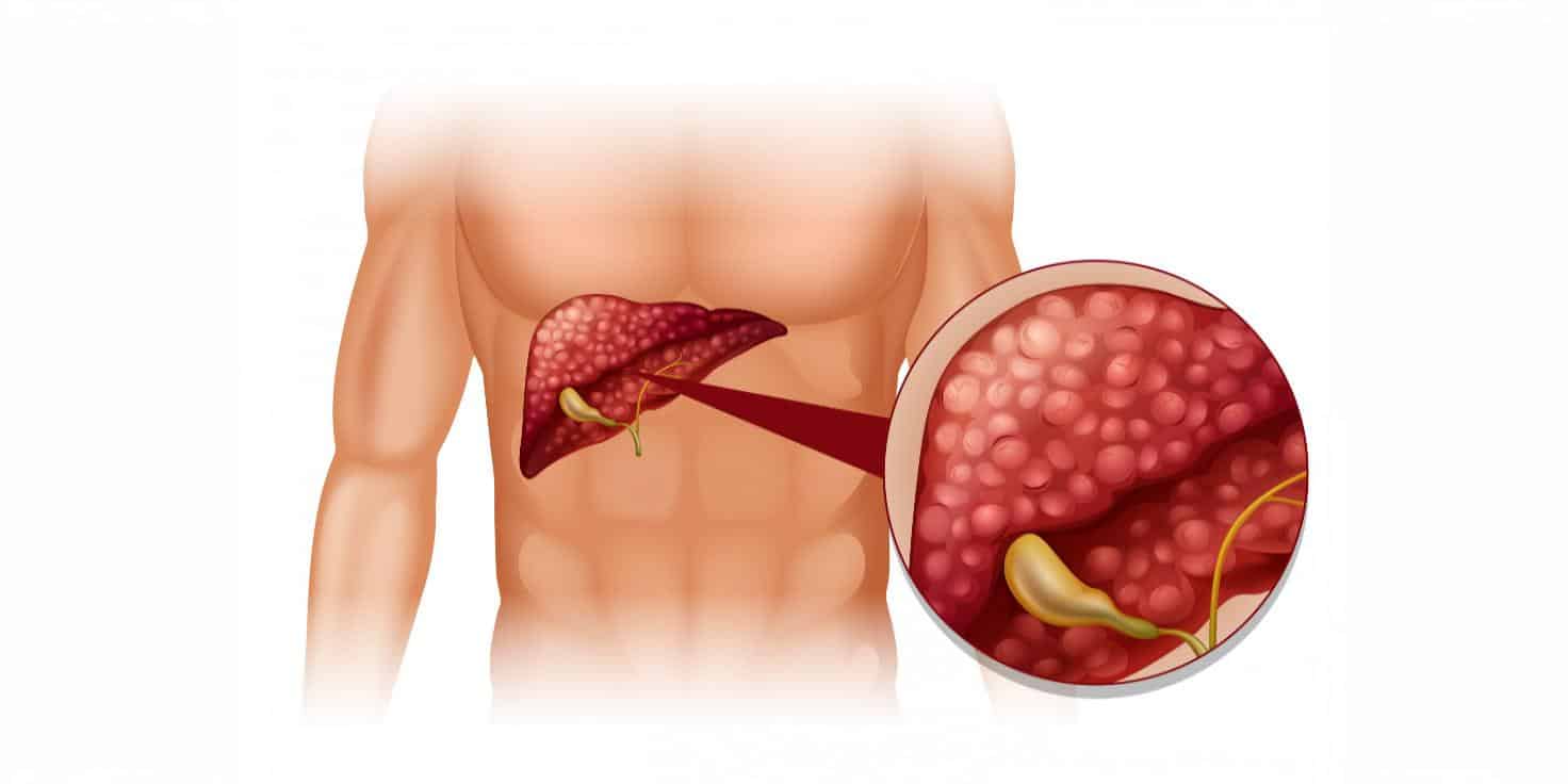 The silent epidemic: Non-Alcoholic Fatty Liver Disease on the rise in India