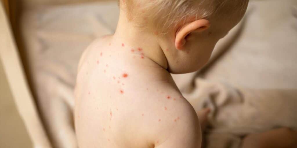 Measles
