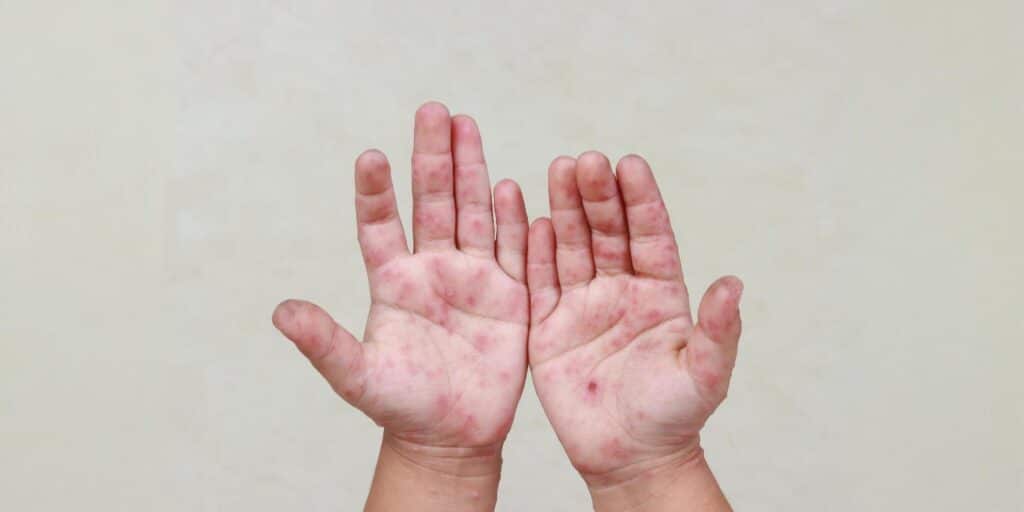 measles