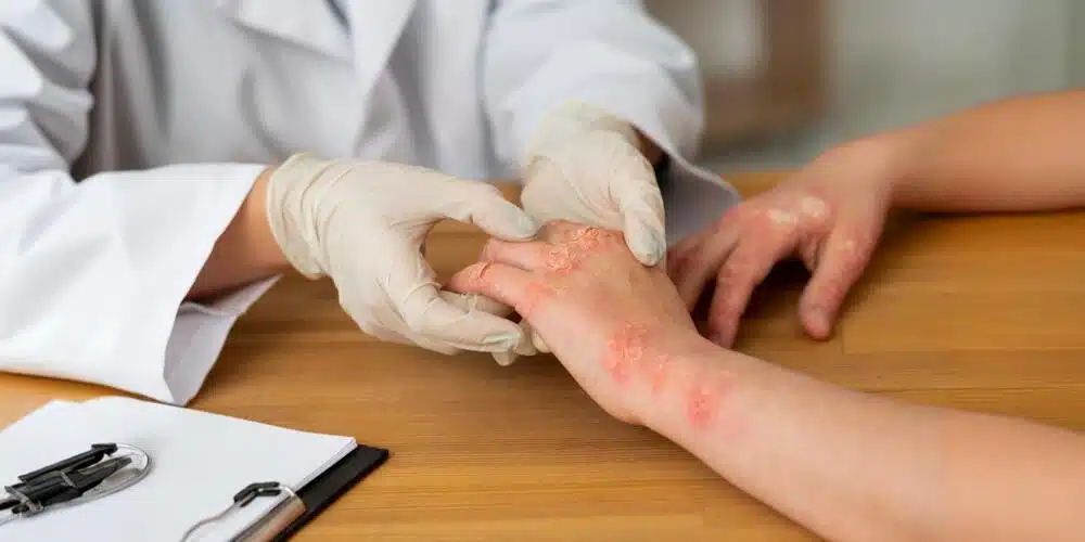 Rising fungal diseases: WHO flags critical gaps in treatment and diagnosis
