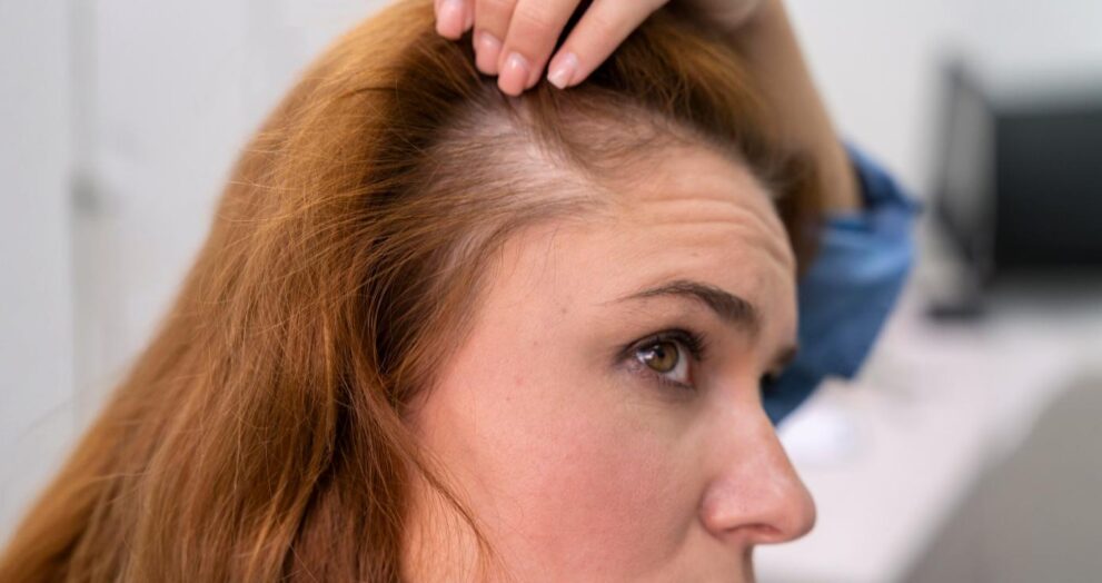 Hair loss