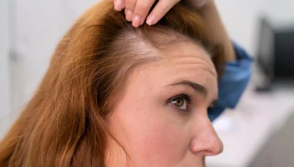Hair loss