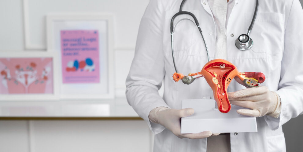 PCOS
