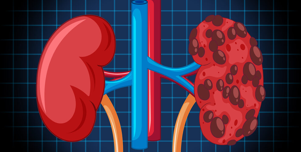 kidney