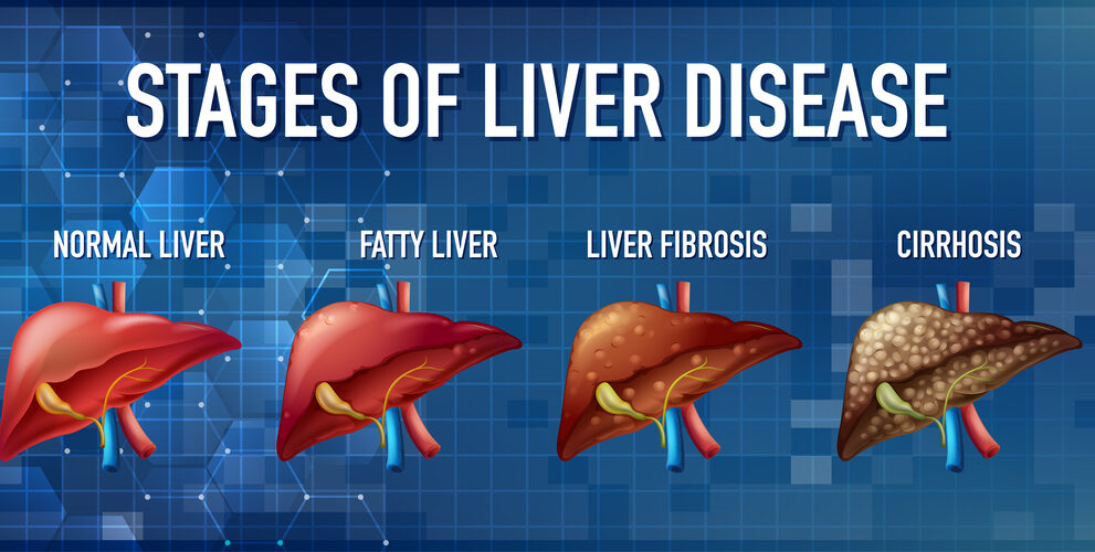 fatty liver
