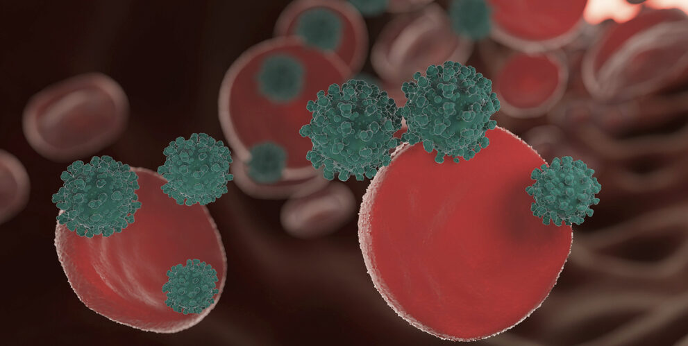 sickle cell disease