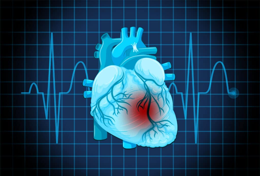 heart attack