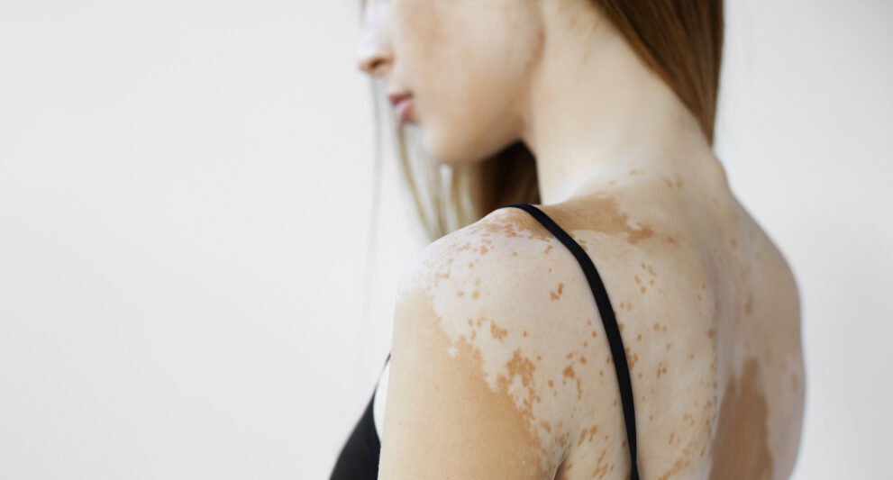 vitiligo