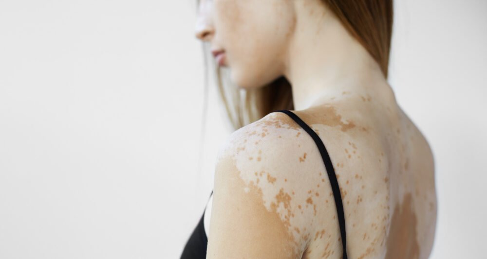 vitiligo