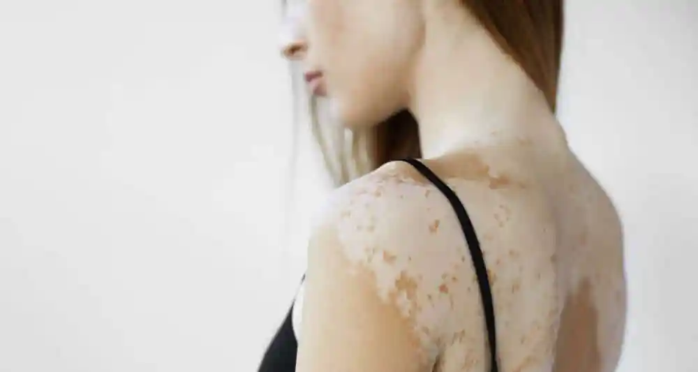 Can vitiligo affect more than your skin? Experts explain its links to the immune system