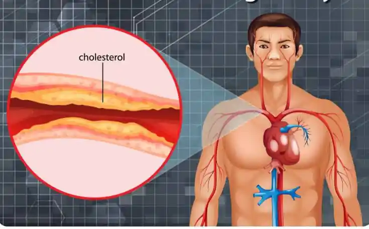 Nearly 9 in 10 Indian adults have unhealthy cholesterol levels, finds national study